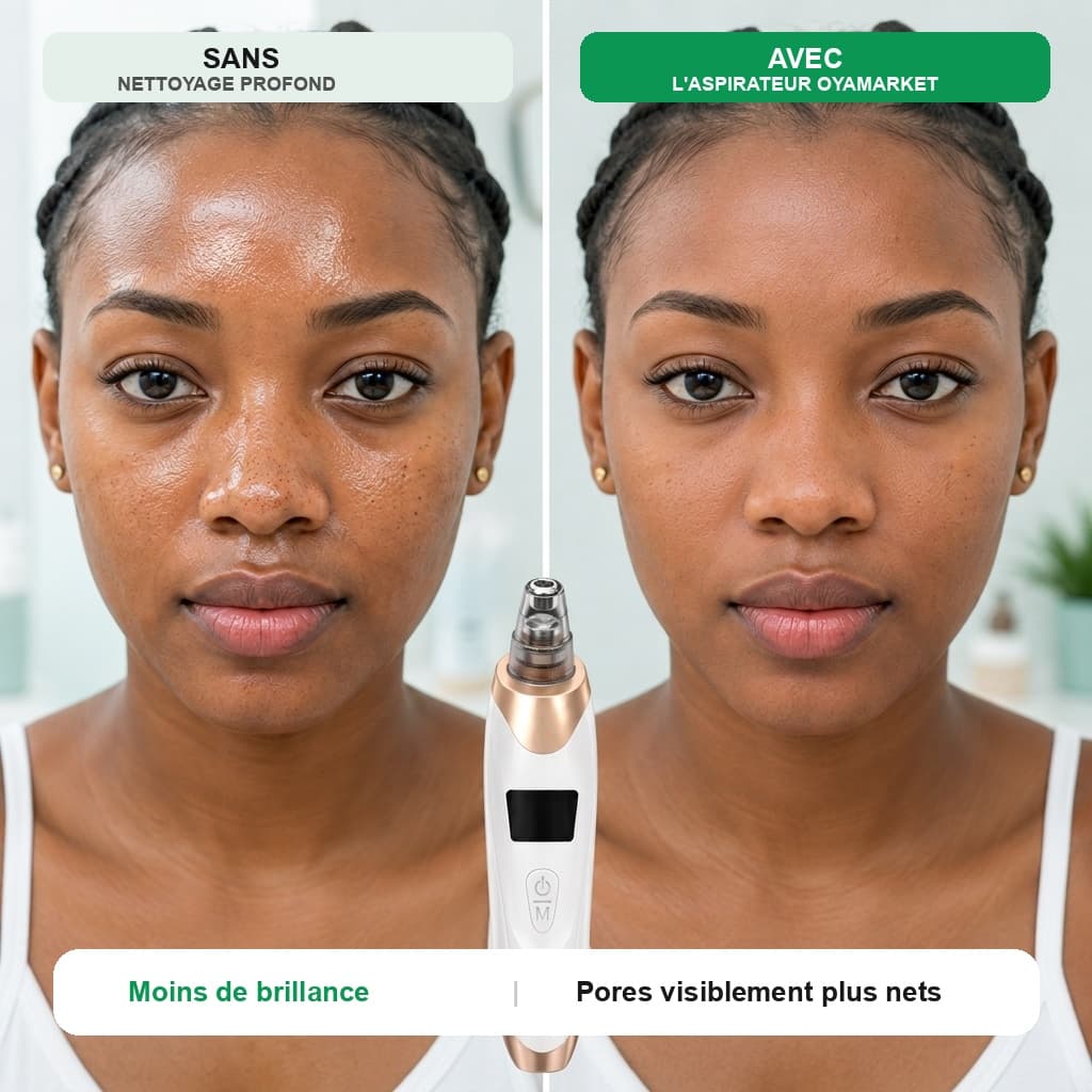 Aspirateur Points Noirs 3-en-1 Pro - Bénéfice 3